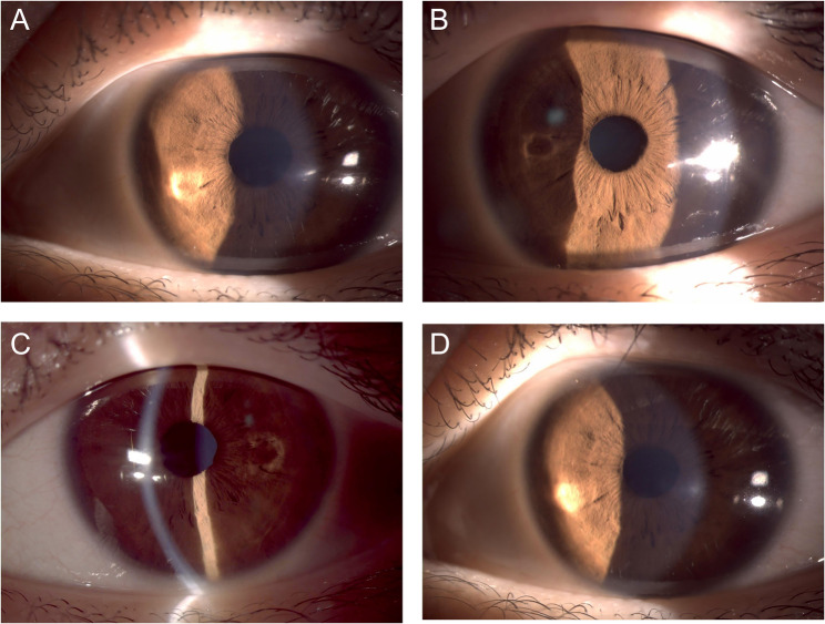 Halo sign in keratoconus: a case report.