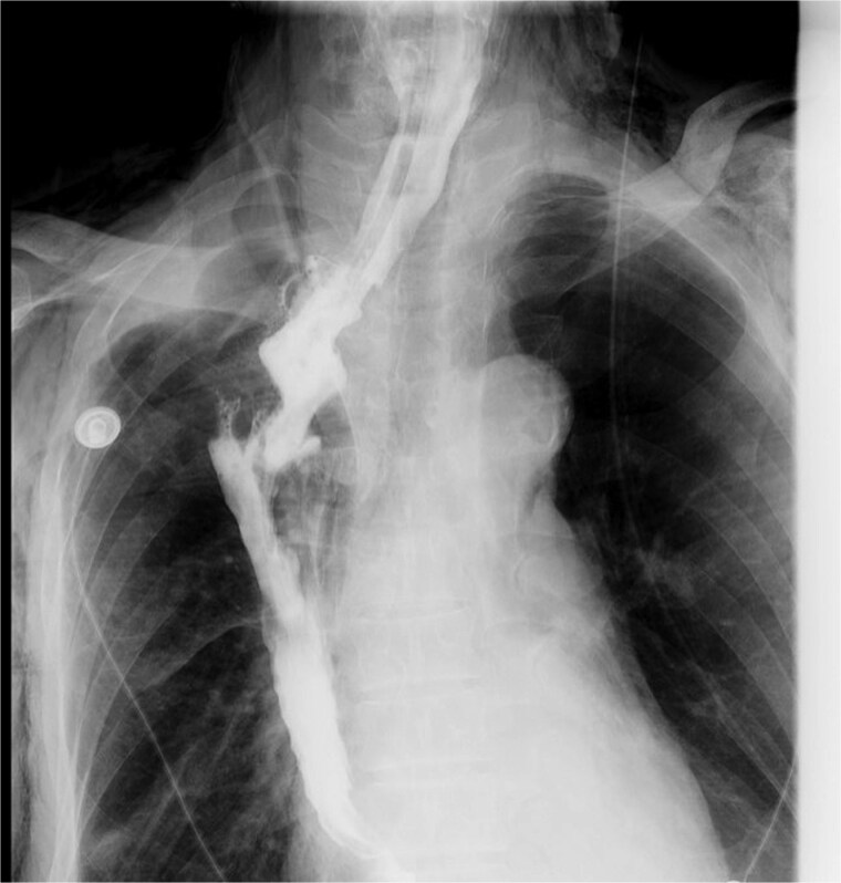 Late-onset esophagogastric anastomotic fistula managed without continuous fasting: a case report.