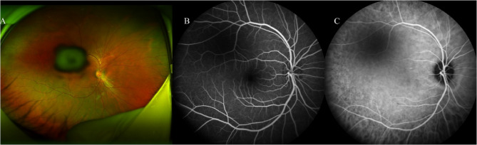 Posterior polar cataract combined with vitreous cysts.