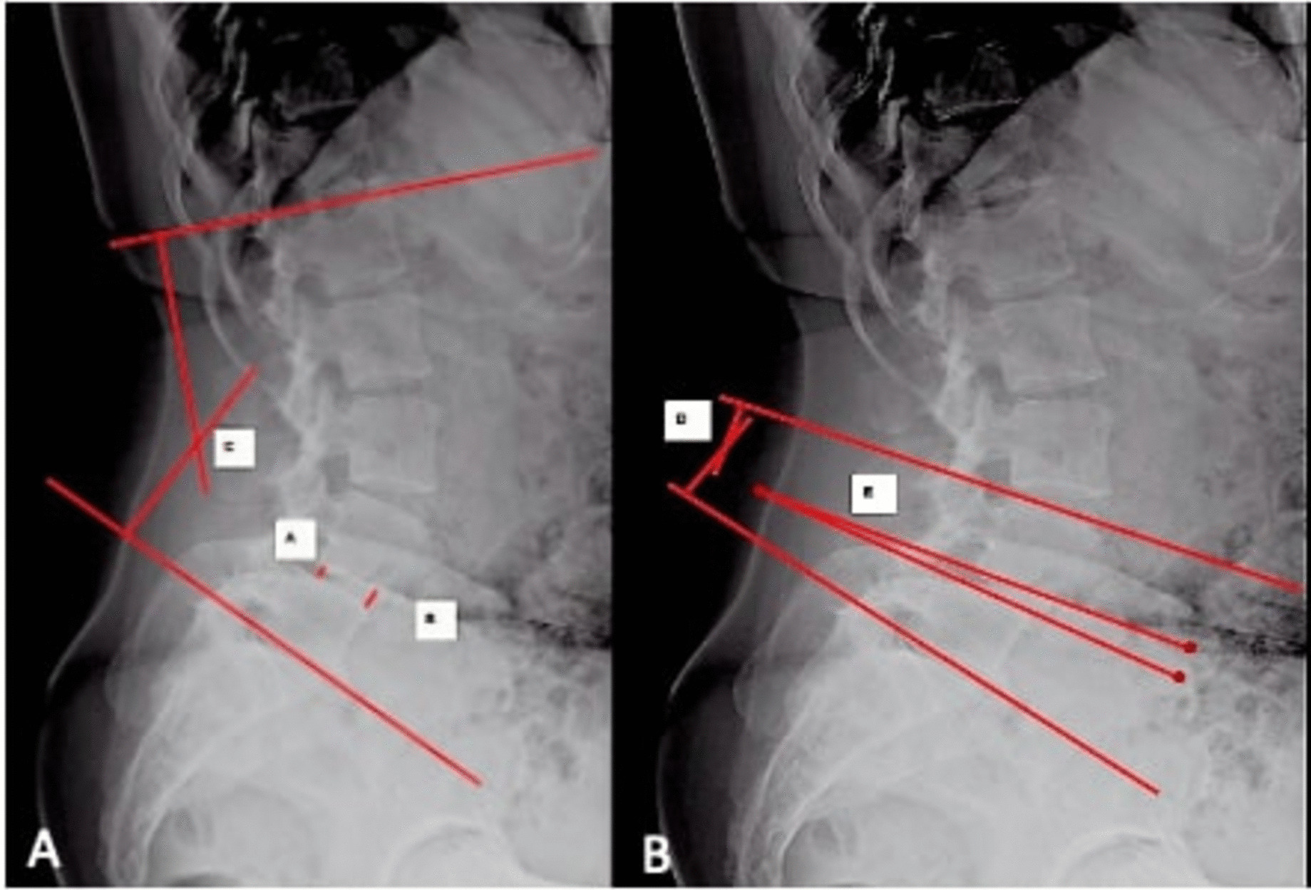 Radiographic and surgical predictive factors for restoring segmental lumbar lordosis and normal spinopelvic balance following TLIF surgery in lumbar spondylolisthesis patients.