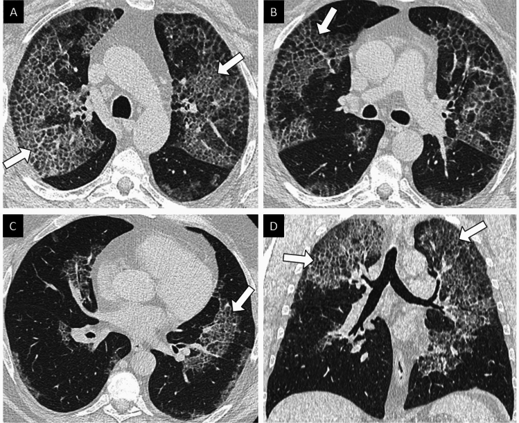 Pharmacotherapy for Autoimmune Pulmonary Alveolar Proteinosis.