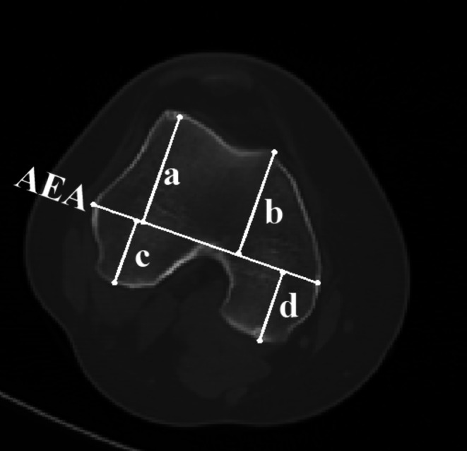 An Unnoticed Femoral Condyle Deformity in Transverse Plane Is Associated With Knee Valgus in Patients With Unilateral Developmental Dysplasia of the Hip.