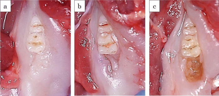 Prevention of bisphosphonate-related osteonecrosis of the jaw with basic fibroblast growth factor: an experimental study in rats.