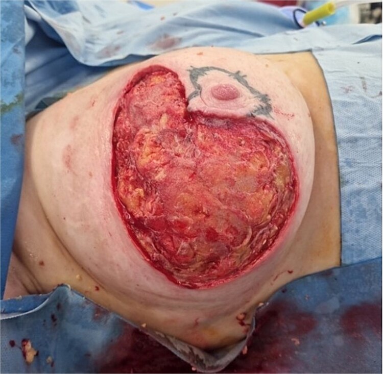 A rare case of necrotic erysipelas of the breast in a healthy, postpartum female.