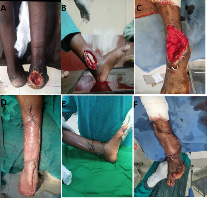 Plastic surgery interventions for war-related injuries: a review of 300 cases from Sudan, a cohort study.