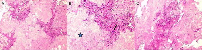 Rare Acute Polyarticular Gout Disease Detected with <sup>18</sup>F-FDG PET/CT.