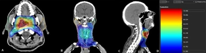 Radiation-induced Xerostomia: Evaluation with <sup>18</sup>F-FDG PET/CT.