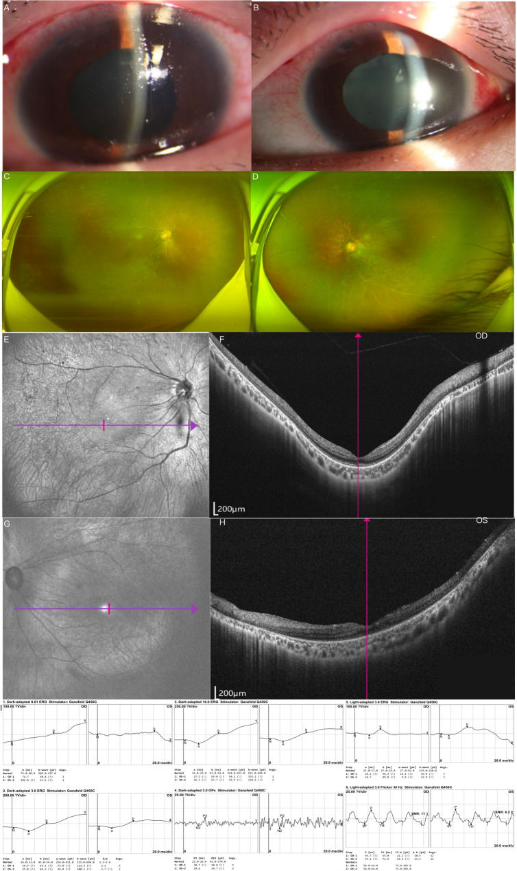 A case of spherophakia-induced angle closure and retinal dysfunction in association with Klinefelter syndrome.