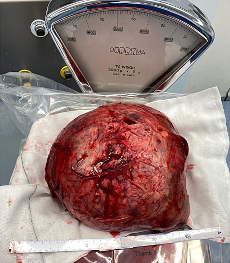 Open repair of a giant hepatic artery aneurysm.