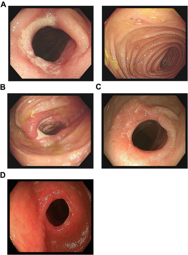 Crohn's disease-like perianastomotic ulcerations after neonatal necrotizing enterocolitis surgery: a case of successful anti-TNF therapy.
