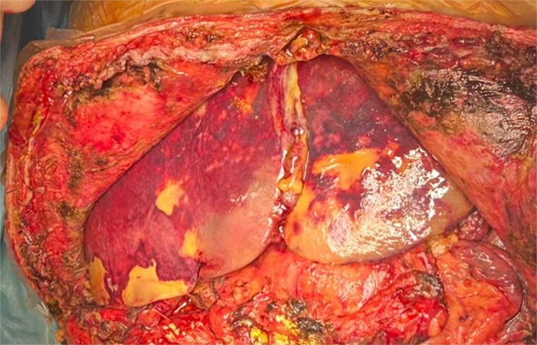 Emergency liver retransplantation for acute arterial thrombosis in a liver multi-transplanted patient: a case report.