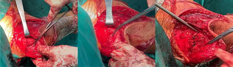 Massive irreparable rotator cuff tear with deltoid tear managed with reverse total shoulder arthroplasty: Case report and review of literature.