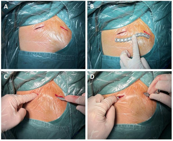 Clinical outcomes of minimally invasive plate osteosynthesis in the management of displaced midshaft clavicle fractures: a case-control study.