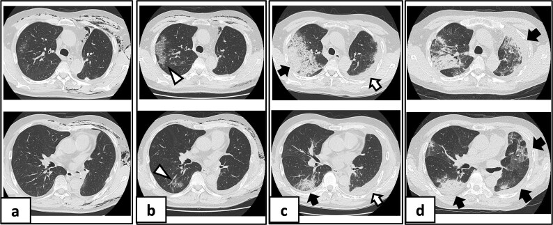 Delayed-onset organizing pneumonia following perioperative COVID-19 after lobectomy.