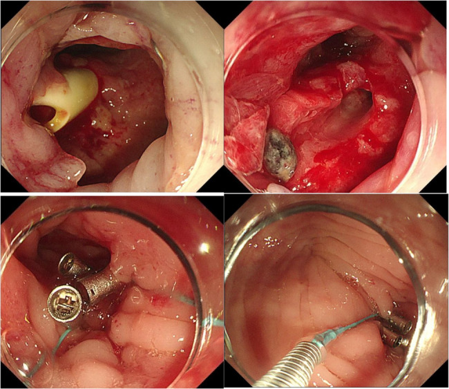 Endoscopic purse-string suture technique for postoperative drain-related leakage management in gastrointestinal surgery.