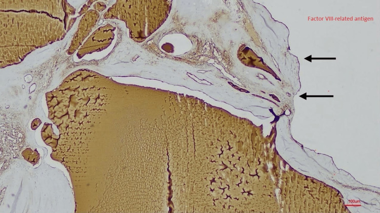An Uncommon Confluence: Splenic Lymphangioma and Appendiceal Mucinous Neoplasm.