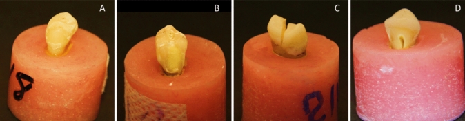 Effect of different cavity designs and CAD/CAM blocks on fracture resistance of maxillary premolars with MOD cavities.