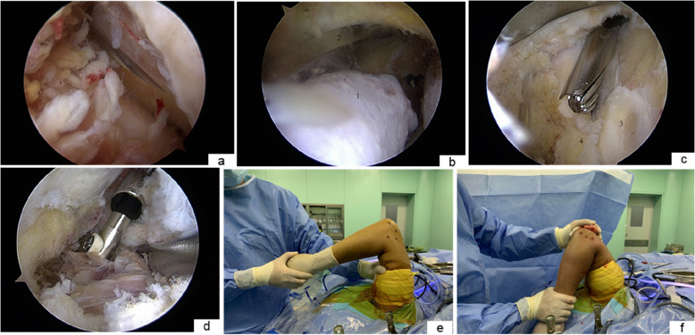 Value of preoperative blocked bone visualization marking on arthroscopic arthroplasty for degenerative elbow stiffness: minimum three-year follow-up.