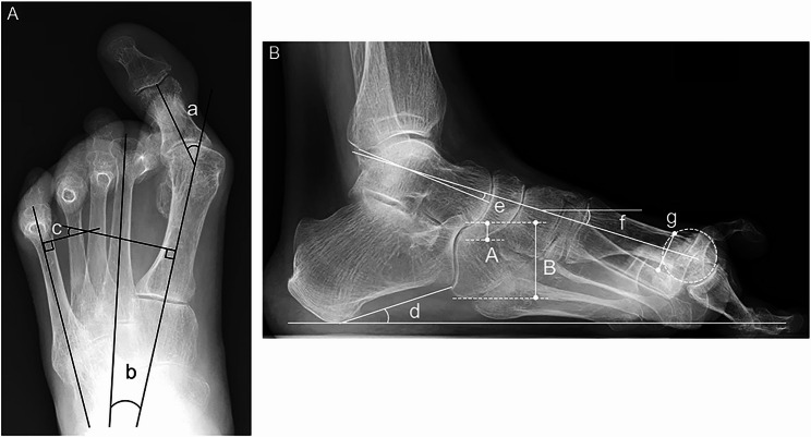 Impact of coronal and sagittal hindfoot alignment on metatarsus primus elevatus in patients with rheumatoid foot deformities.