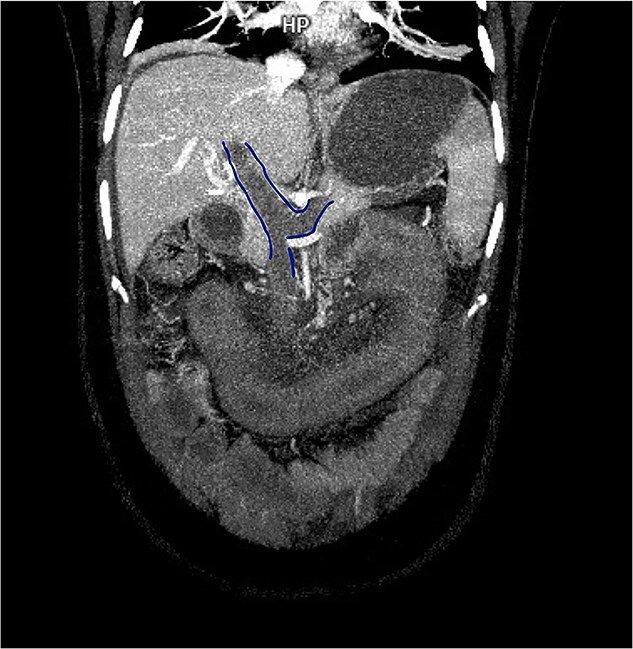Porto-spleno-mesenteric thrombosis secondary to medroxyprogesterone acetate as a treatment for abnormal uterine bleeding: a case report.