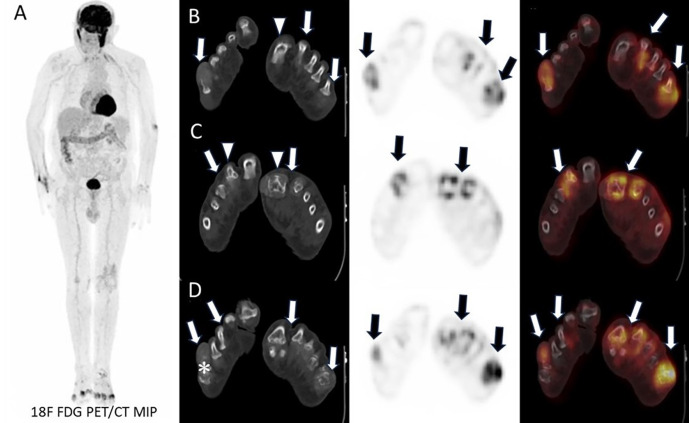 Rare Acute Polyarticular Gout Disease Detected with <sup>18</sup>F-FDG PET/CT.
