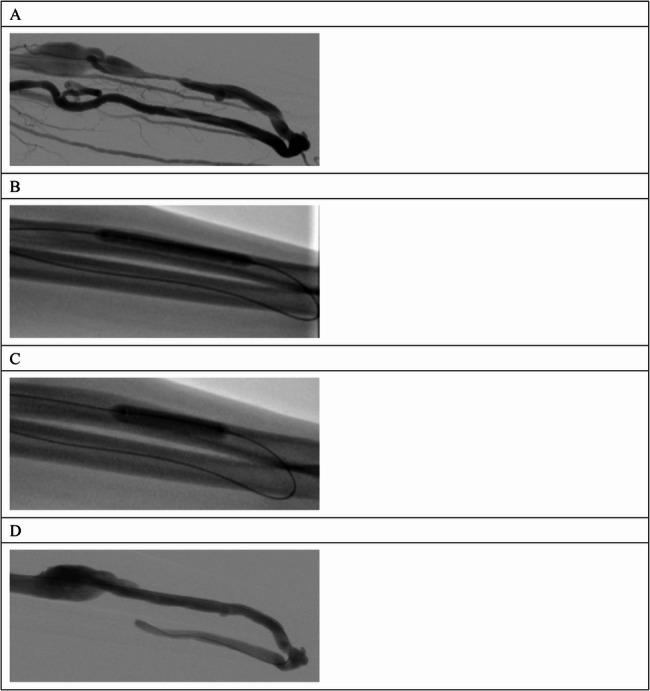 Analysis of the efficacy of drug-coated balloons in the treatment of venous stenosis in hemodialysis access.