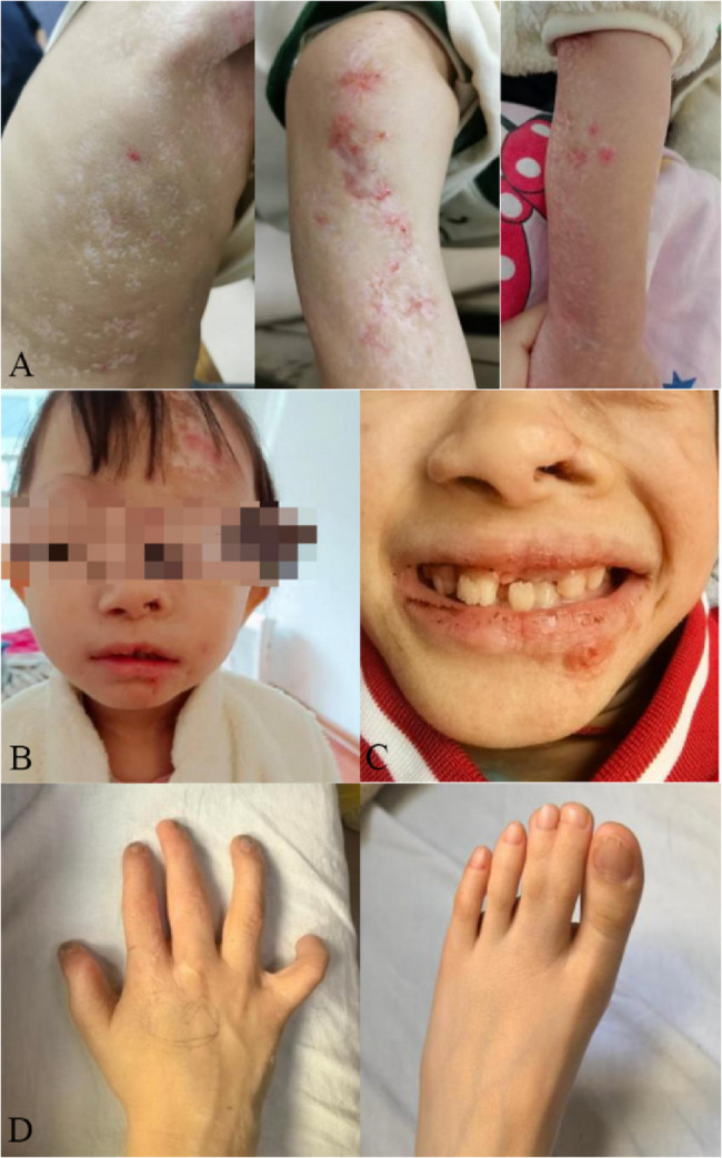 Treatment of a case with short stature and Goltz syndrome with long-acting growth hormone: a case report and follow-up.