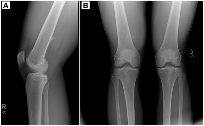 Pseudoaneurysm of the Superficial Femoral Artery Secondary to Exostosis-like Lesion Trauma After Hamstring Tear: A Case Report.