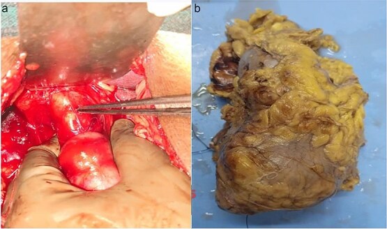 Case report of left renal cell carcinoma with long standing retained common bile duct stent and secondary choledocholithiasis: a single-stage multidisciplinary surgical management in low resource setting.