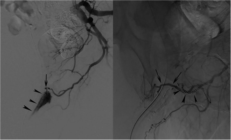 Posttraumatic urethral hemorrhage associated with an arteriospongious fistula and managed with catheter-directed embolization: a report of 2 cases.