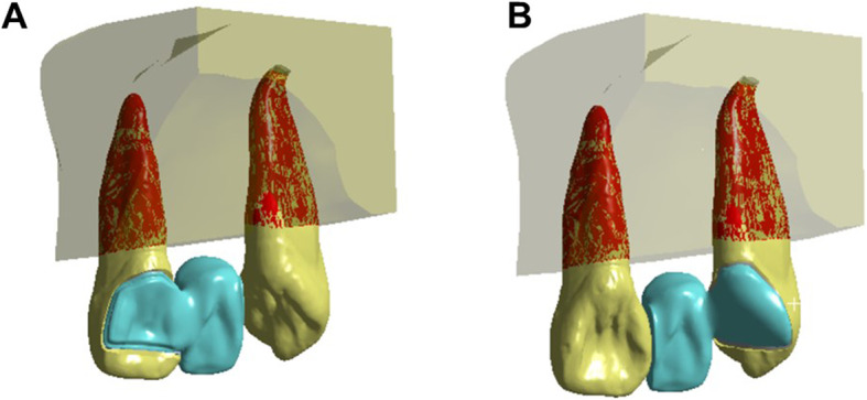 Evaluation of biomechanical behavior of all-ceramic cantilever resin-bonded fixed dental prostheses: a finite element analysis.