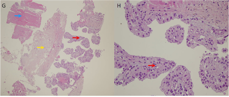 Gluteal Muscle Metastasis of Papillary Thyroid Cancer with Increased Somatostatin Receptor Expression in <sup>68</sup>Ga-DOTATATE PET/MRI.