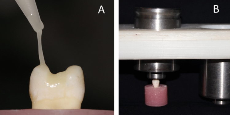 Effect of different cavity designs and CAD/CAM blocks on fracture resistance of maxillary premolars with MOD cavities.