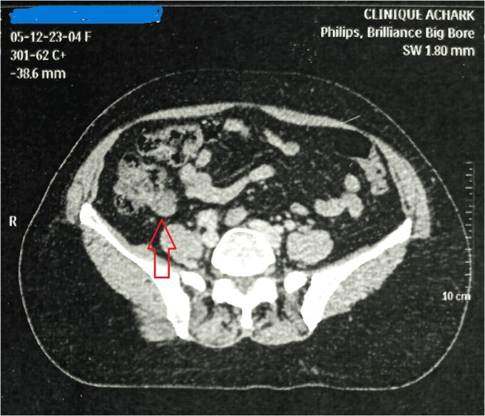 Neuroendocrine tumor of the appendix associated with an appendiceal mucocele: an incidental discovery during breast tumor surveillance.