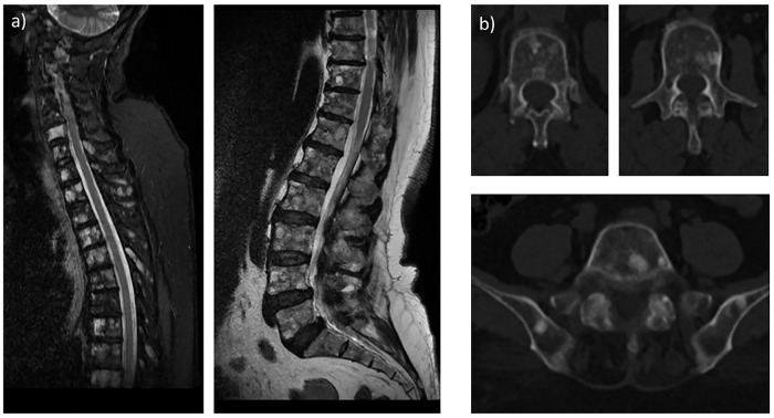 Unveiling the Diagnostic Mystery: <sup>18</sup>F-FDG PET and Bone Scan Negative in Bone Metastases of Lobular Breast Cancer: A Case Report.
