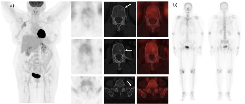 Unveiling the Diagnostic Mystery: <sup>18</sup>F-FDG PET and Bone Scan Negative in Bone Metastases of Lobular Breast Cancer: A Case Report.