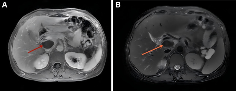 Amyloid cardiomyopathy presenting with gastrointestinal symptoms of abdominal pain, back pain, and constipation: A case report.