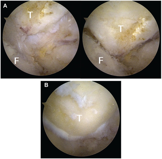 Time to Return to Play After Arthroscopic Elbow Osteocapsular Arthroplasty in Professional and Elite Baseball Players.