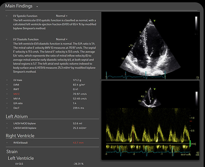 Transforming echocardiography with artificial intelligence.