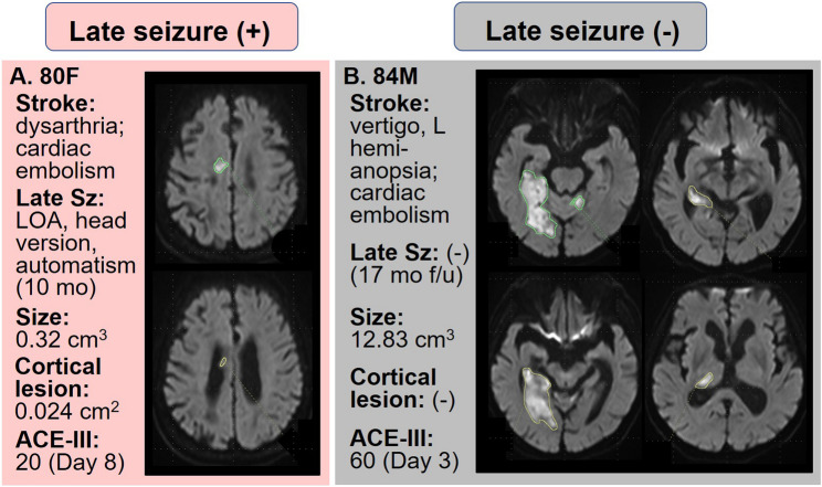 Prediction of late seizures after ischemic stroke using cognitive scores.
