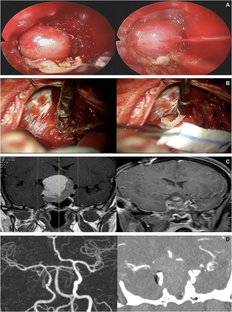 Management of Major Arterial Injuries: A Critical Complication of Endoscopic Endonasal Surgery.