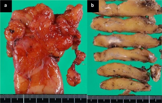 Regressed anterior mediastinal nodule secondary to removal of dental crowns.