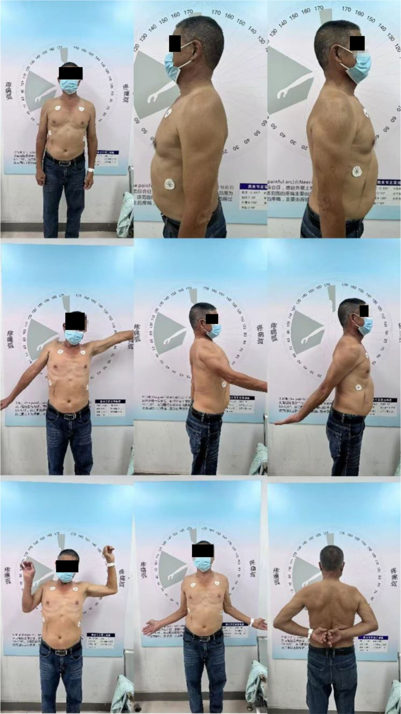 Massive irreparable rotator cuff tear with deltoid tear managed with reverse total shoulder arthroplasty: Case report and review of literature.