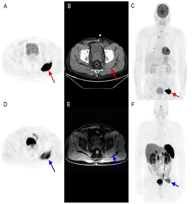 Gluteal Muscle Metastasis of Papillary Thyroid Cancer with Increased Somatostatin Receptor Expression in <sup>68</sup>Ga-DOTATATE PET/MRI.