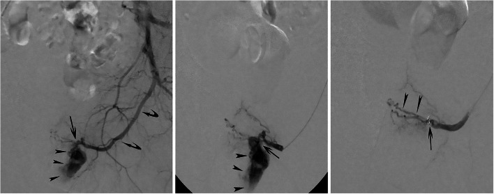 Posttraumatic urethral hemorrhage associated with an arteriospongious fistula and managed with catheter-directed embolization: a report of 2 cases.