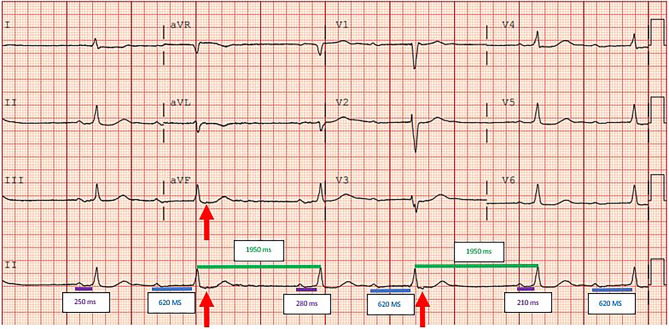 Peculiar conduction.