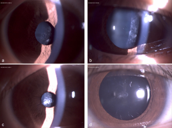 Recurrent 0 μm vault complicated with anterior subcapsular cataract after toric ICL in an eye with multiple anatomical risk factors: clinical reflections.