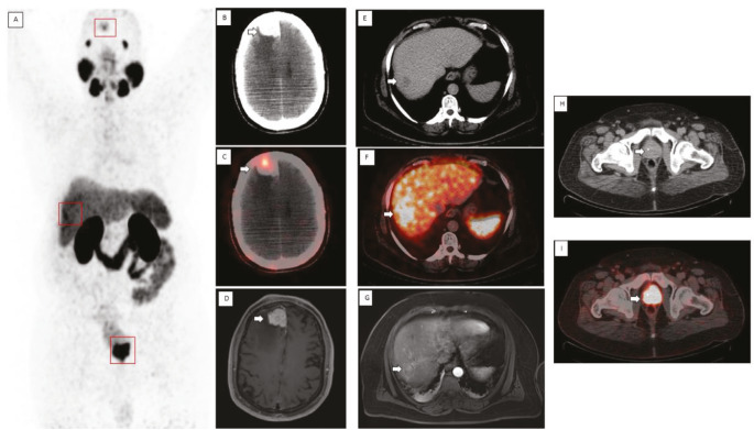 Triple Tumors Uncovered: Insights from <sup>68</sup>Ga PSMA PET-CT.