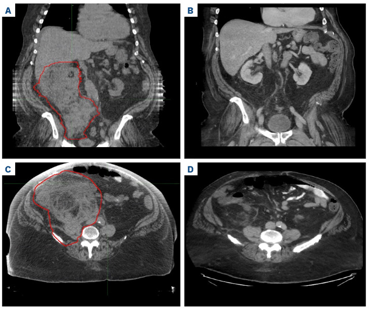 Radiation therapy to manage isolated relapse after chimeric antigen receptor T-cell therapy in multiple myeloma.