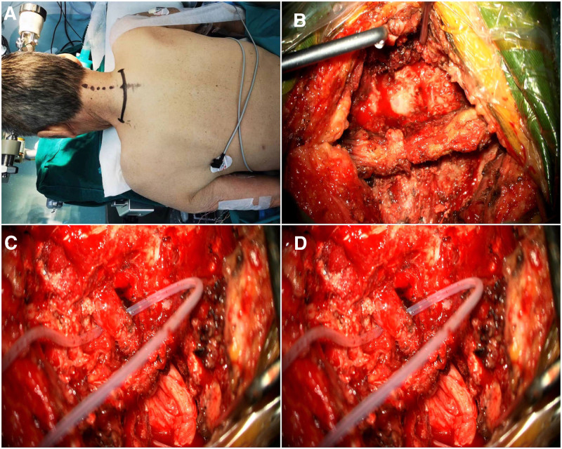 Posterior versus anterior approach for contralateral C7 nerve transfer in post-stroke upper limb spastic hemiplegia: A comparative retrospective study.